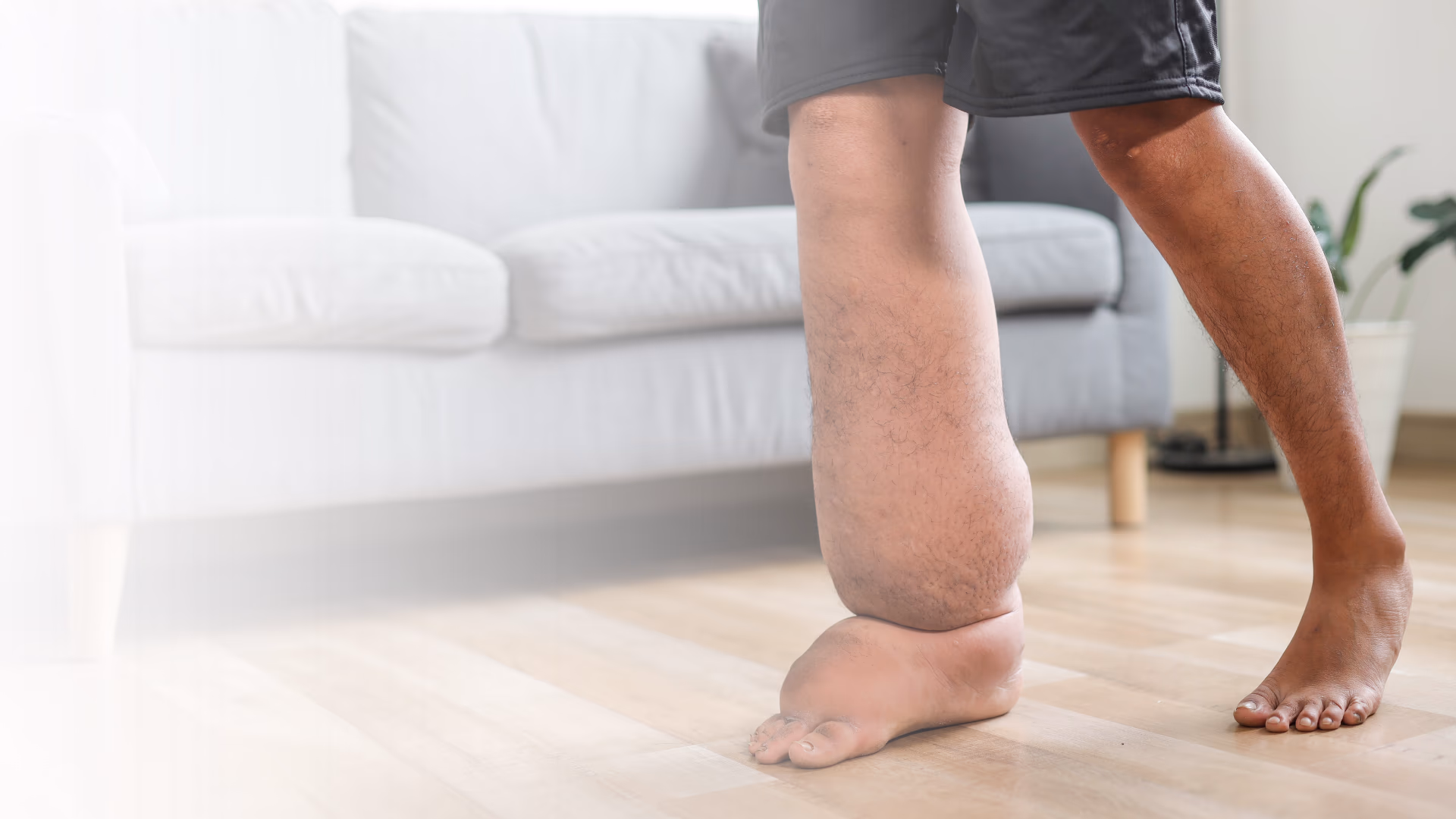 Gambe di un uomo affetto da Lipedema presso il centro Hydrokinesia